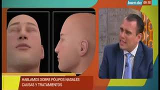 Hablamos sobre los pólipos nasales [upl. by Ellsworth]