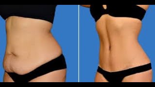 abdominoplastie tout savoir [upl. by Lebatsirhc]