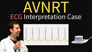 AV Nodal Reentry Tachycardia AVNRT on ECG  EKG [upl. by Sheeran938]