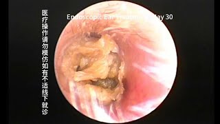 Cholesteatoma that requires regular followup and regular cleaning [upl. by Ylagam]