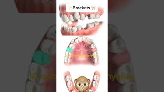 Second premolars extraction orthodontie kieferorthopädie orthodontics ortodonzia ortodoncia [upl. by Arraes]