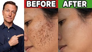 How to Get Rid of Hyperpigmentation Aging or Dark Spots [upl. by Llewej]