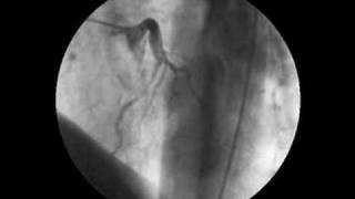 Coronary angiogram  muscle bridge [upl. by Llehcear912]