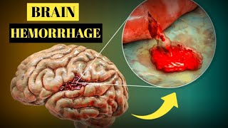 Brain Hemorrhage Causes Symptoms Treatment and Prevention [upl. by Pontone]