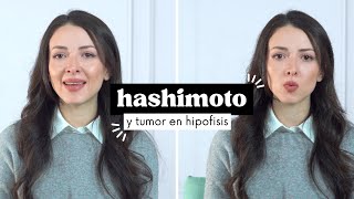 Mis Diagnósticos Enfermedad de Hashimoto  Tumor en la Hipófisis [upl. by Aronaele]