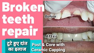 Broken teeth repair  Front teeth ceramic capping  टूटे हुए दांत का इलाज  Post amp Core build up [upl. by Tilda]