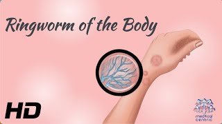 Ringworm of the Body What You Need to Know to Keep Your Skin Healthy [upl. by Ynotna501]