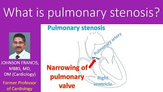 What is pulmonary stenosis [upl. by Branden]