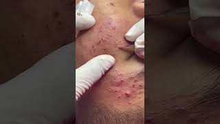 Best Pimple Popping 04 beautiful blackheads sacdepspa [upl. by Marlon]