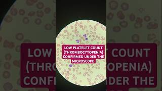 Thrombocytopenia low platelet confirmed under the microscope thrombocytopenia plateletcount [upl. by Tenay2]