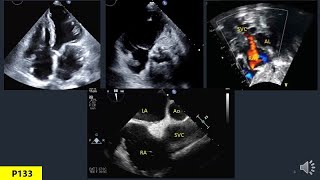 Anatomy Of Heart In Echo Part 6 Right Atrium [upl. by Margarida]