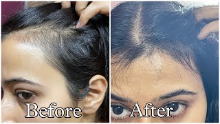 Best Hair Serums For Reduced Hair fall and Hair Growth [upl. by Feldt]