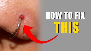 How I Removed My Nose Piercing Bump keloid  SAMADHAN [upl. by Cran]