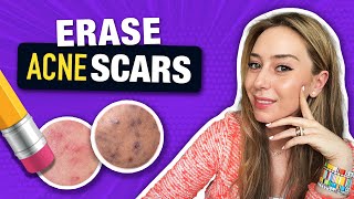 How to Treat amp Fade Acne Scars like a Dermatologist  Dr Shereene Idriss [upl. by Hobie]