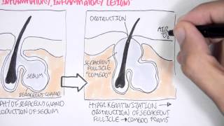 Acne Pathophsyiology [upl. by Uyr]