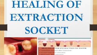 HEALING OF EXTRACTION SOCKET I Oral Pathology I Dental Guide I Dr Bimal Chand I [upl. by Harifaz]