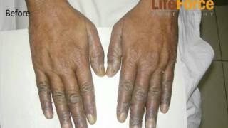 Psoriasis on Palms amp Fingers Treated at Life Force [upl. by Madelon116]