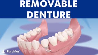 Removable partial denture © [upl. by Averyl450]