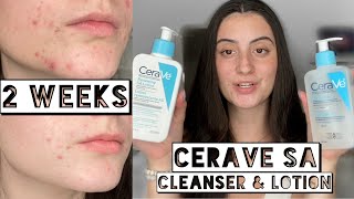 TESTING CERAVE SA CLEANSER amp LOTION ON MY DRY ACNE SKIN FOR 2 WEEKS [upl. by Ichabod]