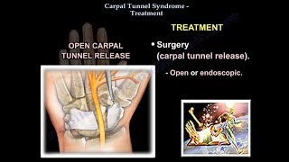 Carpal Tunnel Syndrome Treatment  Everything You Need To Know  Dr Nabil Ebraheim [upl. by Ahsiuqal]