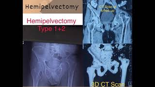 Hemipelvectomy  Life with or without Hip Joint [upl. by Nimrak]