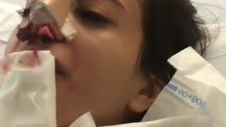 Removal of nondissolving nasal packs after Elite Surgical Rhinoplasty Nosejob by Dr Sultan Hassan [upl. by Sissel]