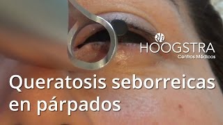 Queratosis seborreicas en párpados  Láser Lotus 16008 [upl. by Prescott547]