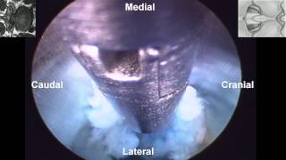 Percutaneous Endoscopic Interlaminar Lumbar Discectomy PEILD by Dr Hyeun Sung Kim01 [upl. by Jonathan3]