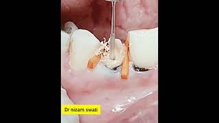 how to open teeths cavity [upl. by Letnuhs685]