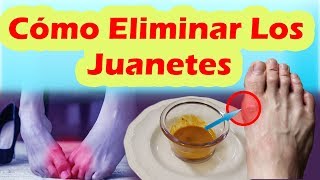 Como Eliminar Los Juanetes De Forma Natural COMO CORREGIR LOS JUANETES SIN CIRUGÍA [upl. by Ynoyrb]