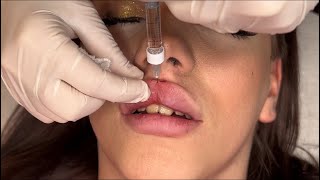 How to Safely Inject Lip Filler for Best Results [upl. by Ydniw]