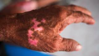 Leprosy  a Chronic Infectious Disease [upl. by Eikcaj599]