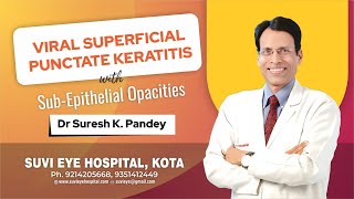 Viral Superficial Punctate Keratitis with SubEpithelial Opacities at SuVi Eye Institute Kota India [upl. by Braca475]