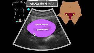 POCUS Female Pelvis Transabdominal scanning sequence [upl. by Ylecic]