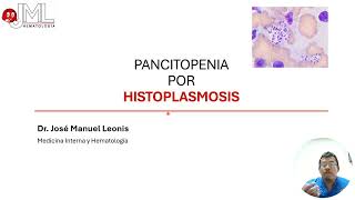 PANCITOPENIA  HISTOPLASMOSIS [upl. by Gene]