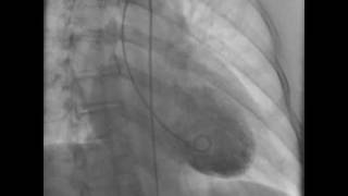 Takotsubo Cardiomyopathy Caught on Tape [upl. by Oliviero]