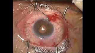 CIRUGIA DEL GLAUCOMA DISPOSITIVO XEN [upl. by Noswal349]