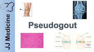 Pseudogout  Pathophysiology Symptoms and Treatment [upl. by Leik]