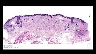 Desmoplastic Trichoepithelioma explained by a dermatopathologist Stain Summary in description [upl. by Hanae]