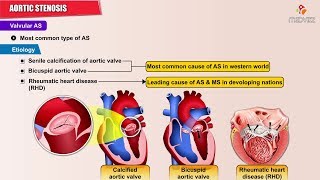 Aortic Stenosis  Causes  Symptoms  Pathology  Diagnosis and Treatment [upl. by Loseff]