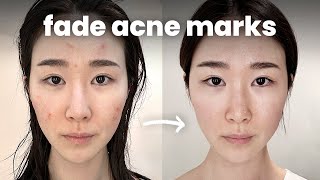 How I Fade Acne Marks Fast Acne Scars amp Hyperpigmentation [upl. by Michal]