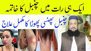 Chambal Ka Ilaj Psoriasis Treatment In UrduWhat Is PsoriasisPsoriasis Treatment  Hakeem Mehmood [upl. by Aloz785]