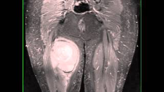 Synovial Sarcoma Thigh [upl. by Erl]