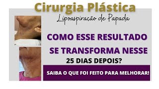 Antes e depois Lipo de papada resultado imediato fibroses tratamento drenagem pósoperatório [upl. by Tehc118]