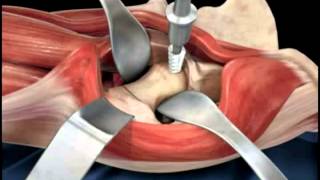 Hip replacement surgery techniques  Dr Scott Devinney [upl. by Leizar57]