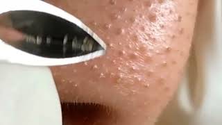 Acnes Treatment  how to remove small pimples from face and forehead  white pimples  blackheads [upl. by Franzen]