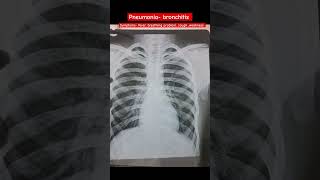 pneumonia bronchitis radiology chest xray medical doctors youtubeshorts [upl. by Donnamarie]