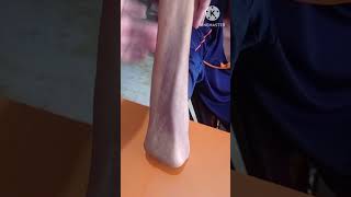 olecranon fracture physiotherapy exercise1 years full recovery olecranon [upl. by Winwaloe]