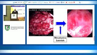 5ASA en colitis ulcerativa ¿Cúando y cómo Dr William Otero [upl. by Lole389]