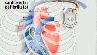 How pacemakers work [upl. by Trudie]